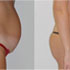 addominoplastica
