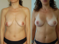 mastopessi-protesi2-png