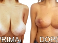 mastoplastica riduttiva