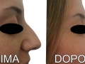 rinoplastica11