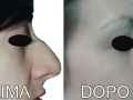 rinoplastica44
