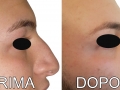 rinoplastica55