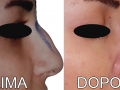 rinoplastica6